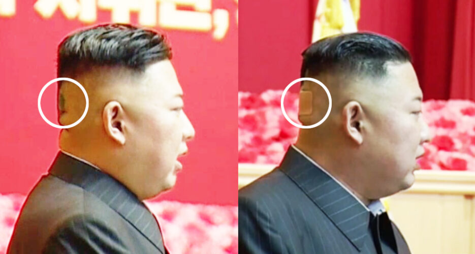 Mysterious spot and bandage appear on back of Kim Jong Un’s head